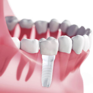 brunswick dental implants